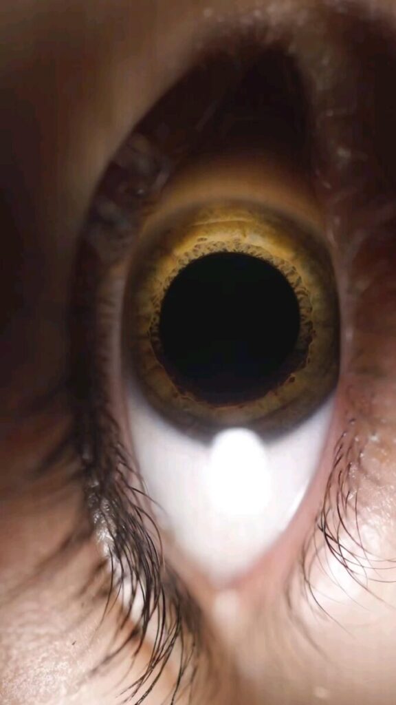 tension dans les yeux symptômes