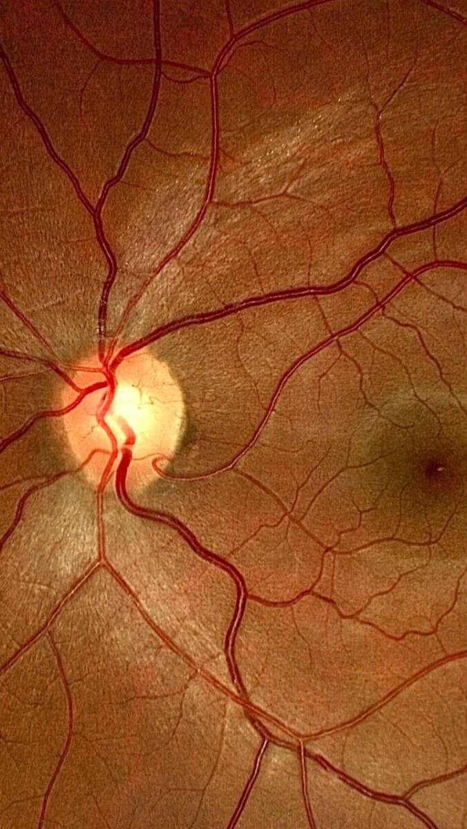 tension dans les yeux symptômes