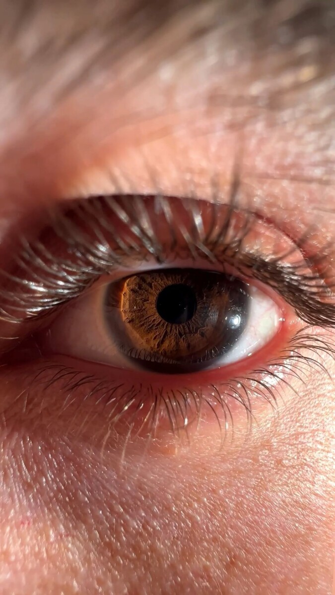 tension dans les yeux symptômes