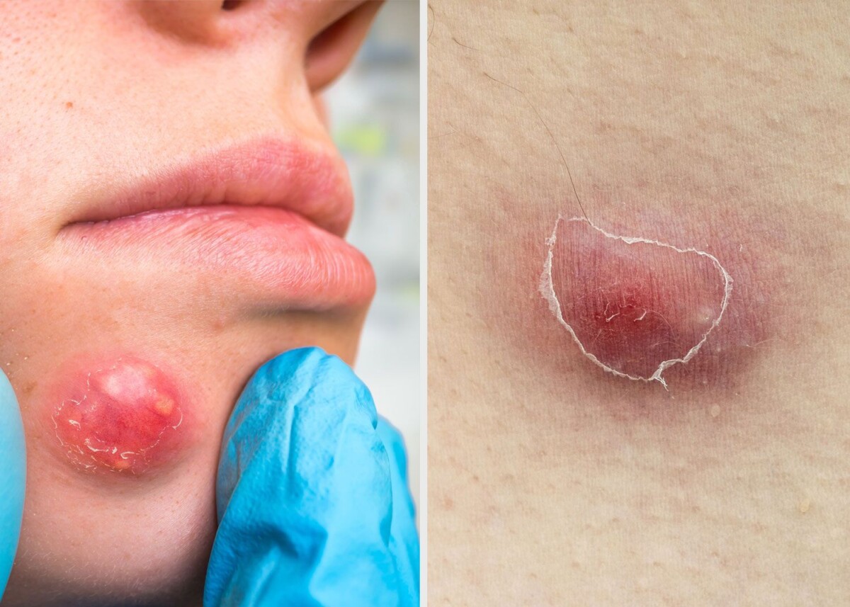 Furoncle Pubien Soulager Remèdes