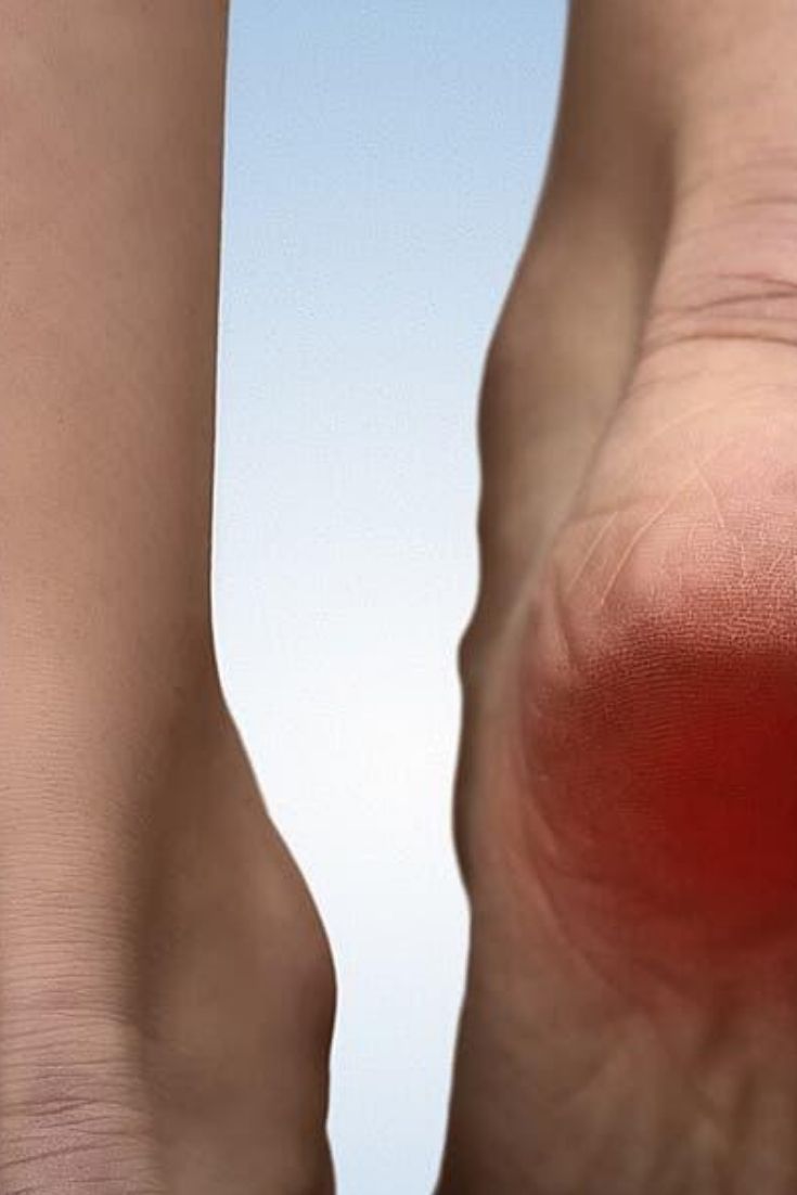 Éperon Calcanéen Solutions Naturelles