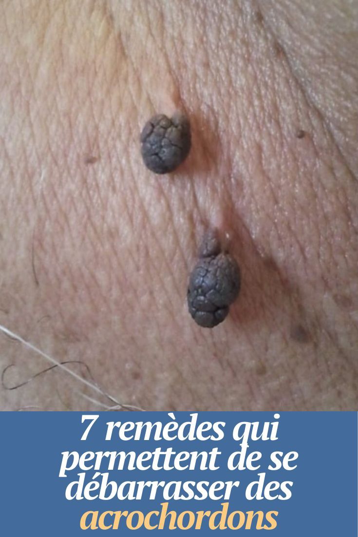 Furoncle Pubien Remèdes Maison