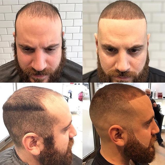 Calvitie Styles Tendance