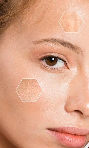 points noirs soin visage