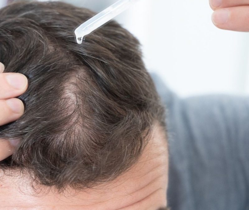 Vapotage et perte de cheveux : Tout savoir en 2026