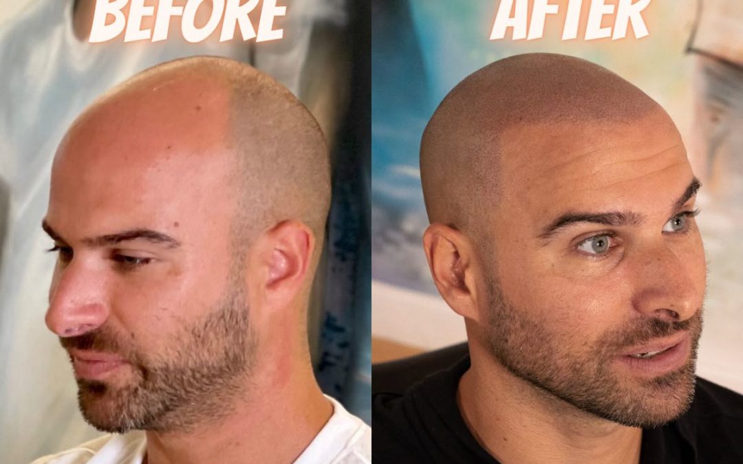 Tricopigmentation homme : la solution discrète pour redessiner sa densité capillaire à Paris