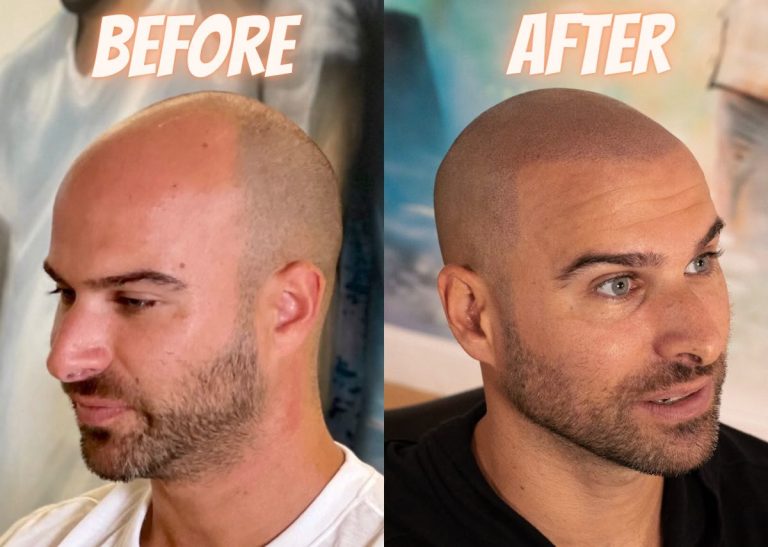 Tricopigmentation homme