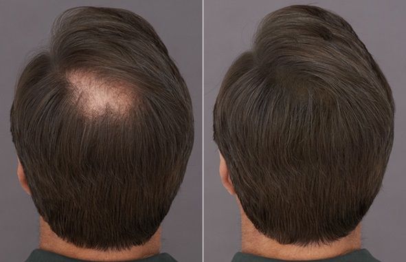 Tricopigmentation homme